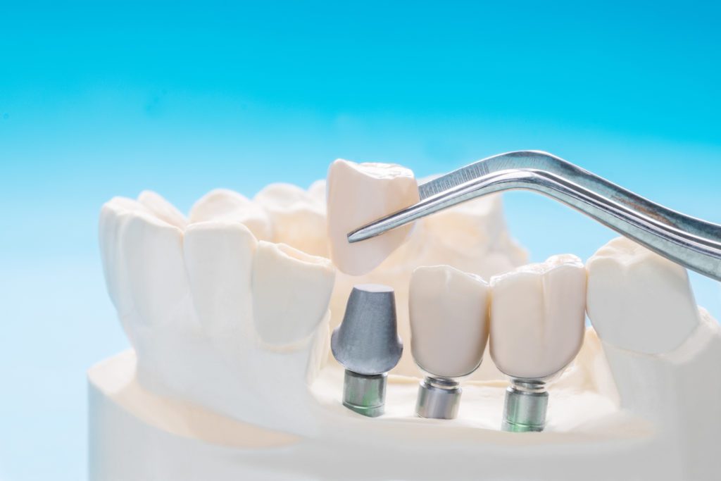 Dental Bridges in Oxford, Pennsylvania