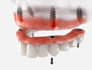 Beyond the Traditional Denture: Implants in Oxford, PA