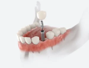The Dental Implant Procedure: A Step-by-Step Guide Oxford, PA
