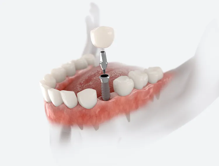 The Dental Implant Procedure: A Step-by-Step Guide Oxford, PA
