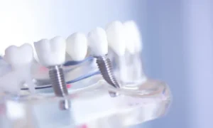 Dental Implant or Bridge? How to Choose in Oxford, PA